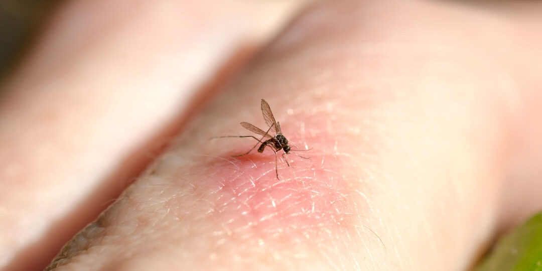 mosquito bites
