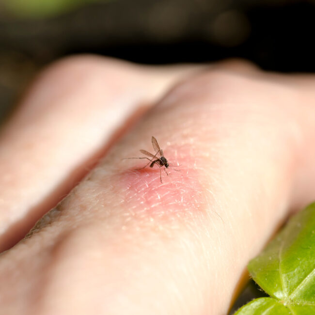 mosquito bites